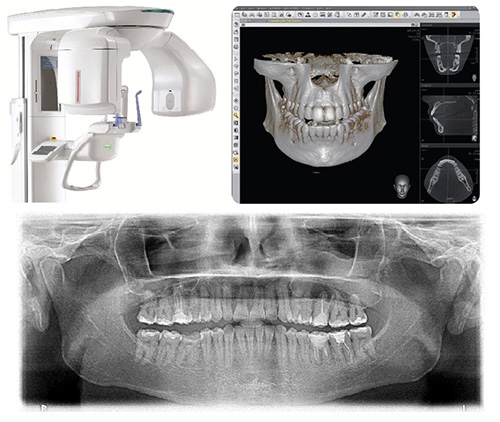 Компьютерная томография зубов (дентальная)
